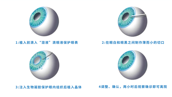 ICL手術(shù)