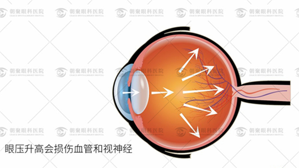 睫狀體冷凝術(shù)